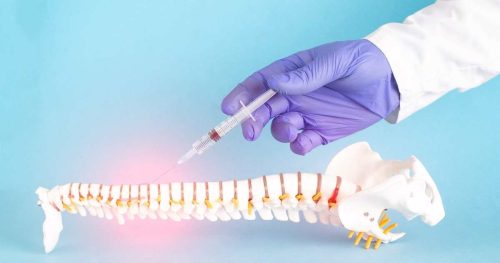 epidural placement